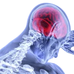 ictus, TCE, daño cerebral, parkinson, esclerosis multiple